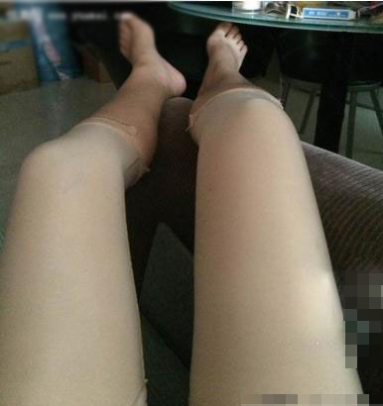 大腿環(huán)吸脂