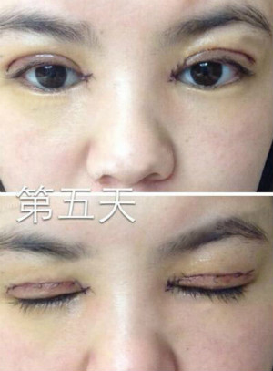 術(shù)后第5天