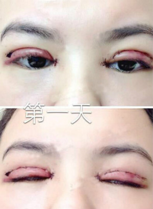術(shù)后第1天