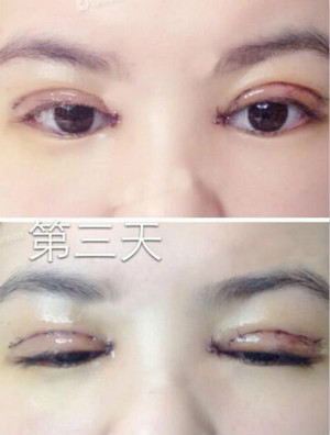 術(shù)后第3天