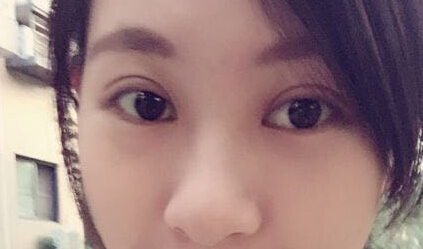 一個(gè)月后的雙眼皮