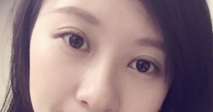 雙眼皮一個(gè)月后美照