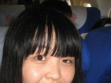 眼瞼下垂矯正術(shù)前照