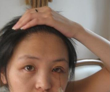 眼瞼下垂矯正術(shù)后半個效果圖