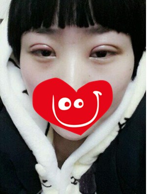 雙眼皮手術后