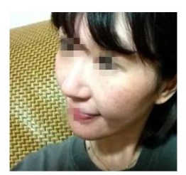 激光祛斑,心情像撿到寶