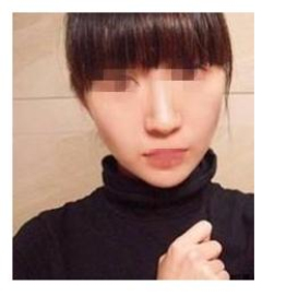 激光祛斑,心情像撿到寶