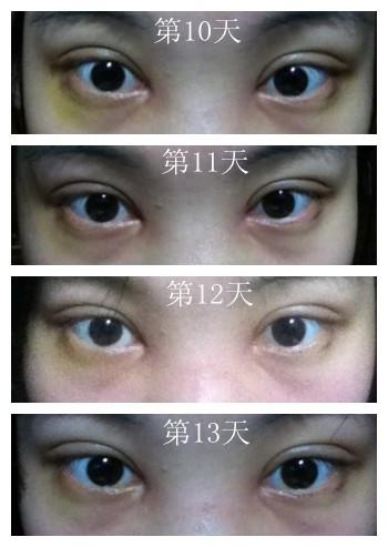 雙眼皮+內(nèi)眼角