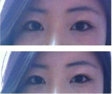 割雙眼皮，讓我擁有了美麗的大眼