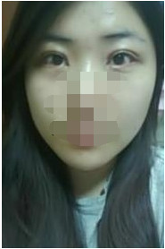 割雙眼皮，讓我擁有了美麗的大眼