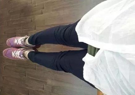 小腿吸脂手術(shù)后