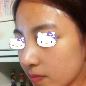 術后第35天