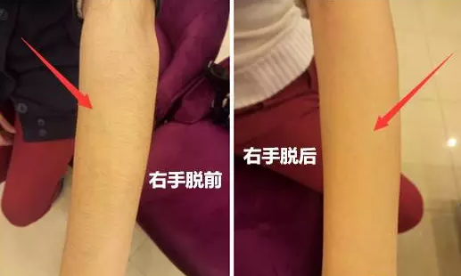 激光脫前臂毛