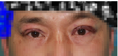 我做了上瞼下垂手術(shù)，感覺挺好的