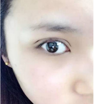 雙眼皮術(shù)后第一天