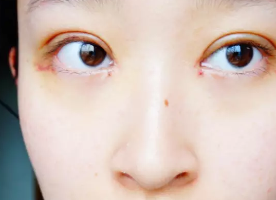 翹睫美瞳術(shù)