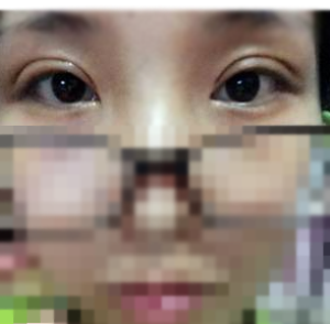 雙眼皮修復(fù)讓我的愛美旅程起航！