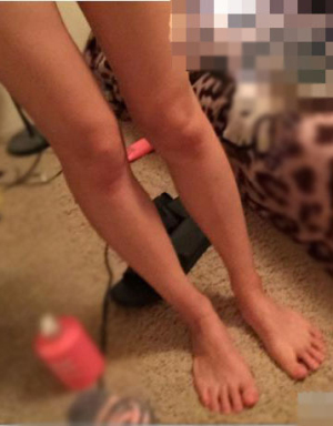 吸脂瘦小腿，美慘了