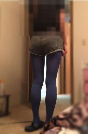 吸脂瘦小腿，美慘了