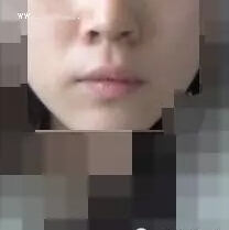 鼻翼縮小術(shù)后效果