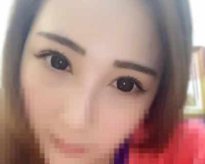 我的雙眼皮手術(shù)，很成功。
