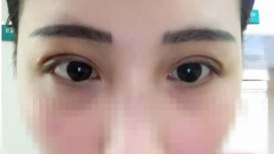 我的雙眼皮手術(shù)，很成功。