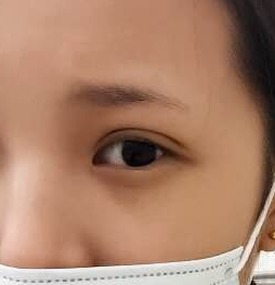 雙眼皮