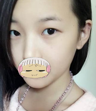雙眼皮