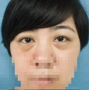 激光去眼袋前的樣子