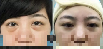 激光去眼袋效果對比圖