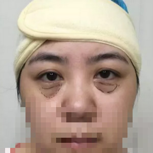 手術(shù)設(shè)計(jì)