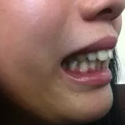 牙齒正畸前