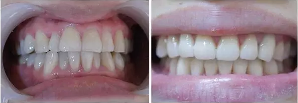 全透明隱形正畸