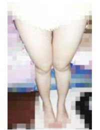 大小腿吸脂，讓我越來越愛自拍了