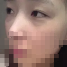 去眼袋手術(shù)前