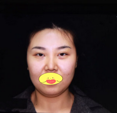 江西面部吸脂