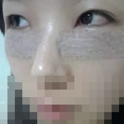 去眼袋手術(shù)后第二天