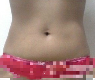 江西腰腹部吸脂