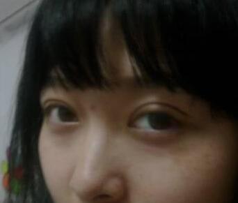 雙眼皮