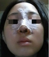 假體隆鼻
