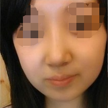 假體隆鼻手術(shù)效果