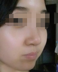隆鼻效果