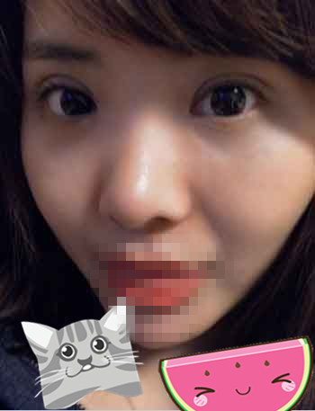 雙眼皮+開眼角