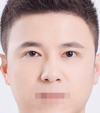 雙眼皮手術
