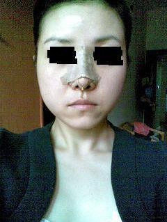 假體隆鼻