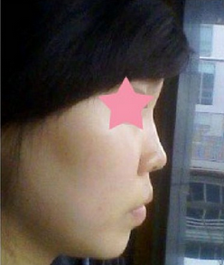 鼻綜合整形手術(shù)后
