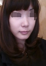 硅膠假體隆鼻前