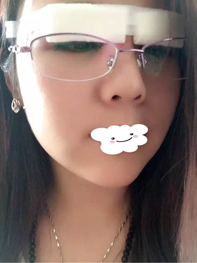 北京雙眼皮