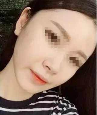 下頜角整形