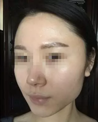 下頜角整形